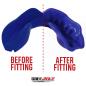 SafeJawz Intro Series Blue Mouthguard - Before/After